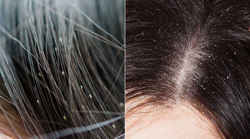 درمان شپش موی سر با سرکه